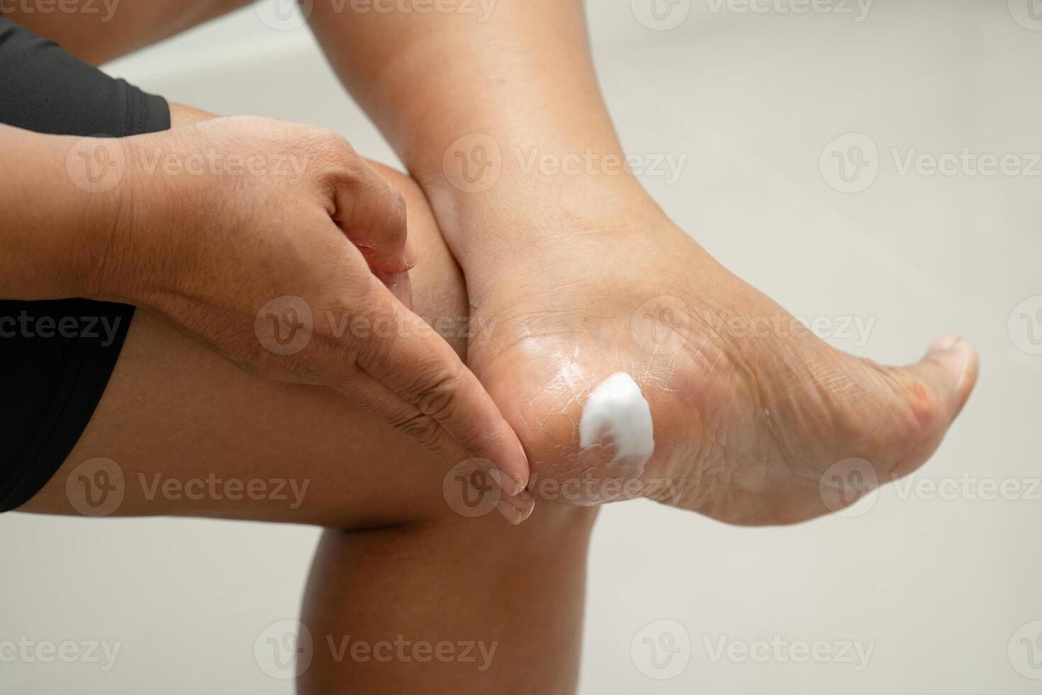 woman care feet with cracked and dry heel skin cream photo