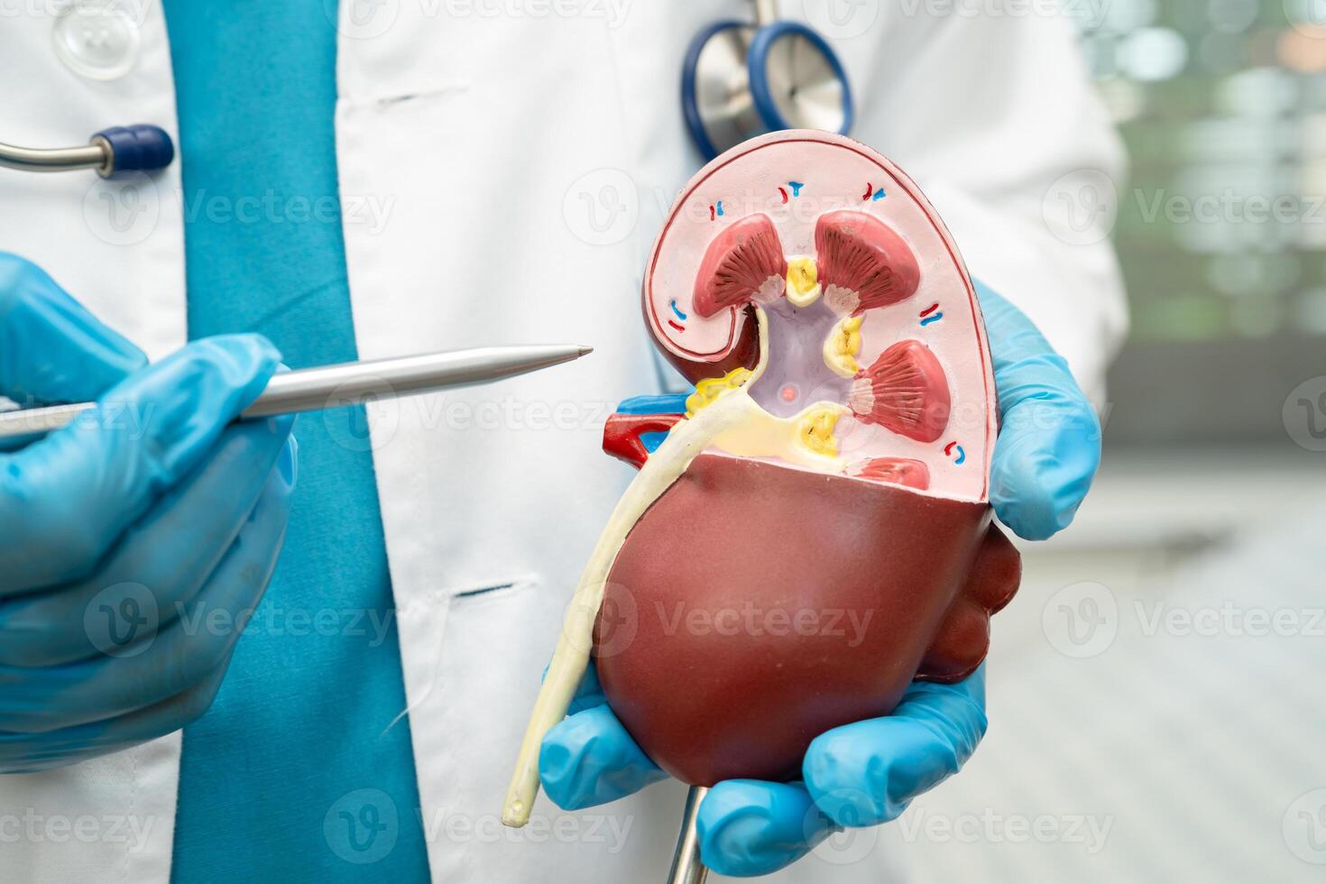 Kidney disease Chronic kidney disease ckd for treatment photo