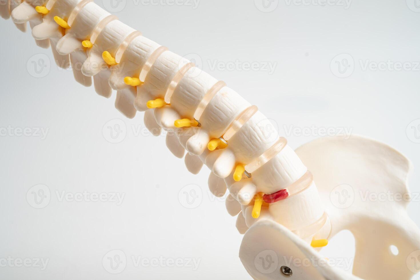 Lumbar spine displaced herniated disc fragment, spinal nerve and bone. Model treatment medical photo