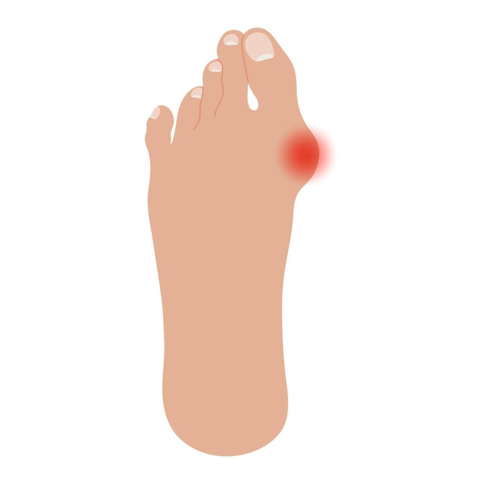 Bare foot with Hallux valgus deformation. Human foot sole with deformities of big toe joint vector