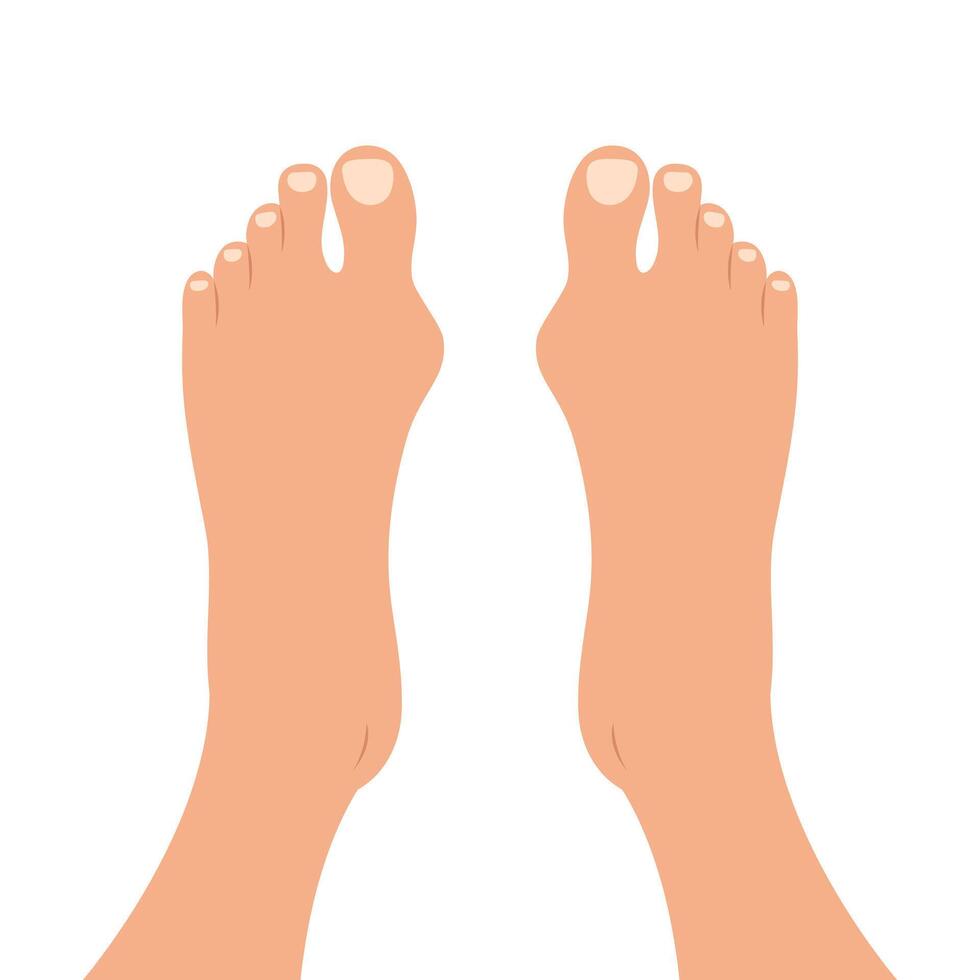 Human feet with deformities of big toe joint. Top view of bare feet with Hallux valgus deformation vector