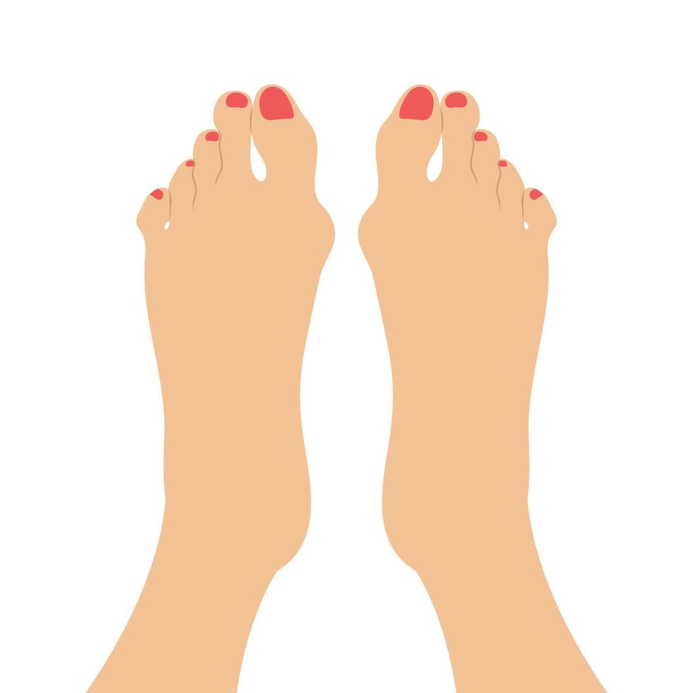 Women feet with a Hallux valgus deformation. Bunion of a big toe vector