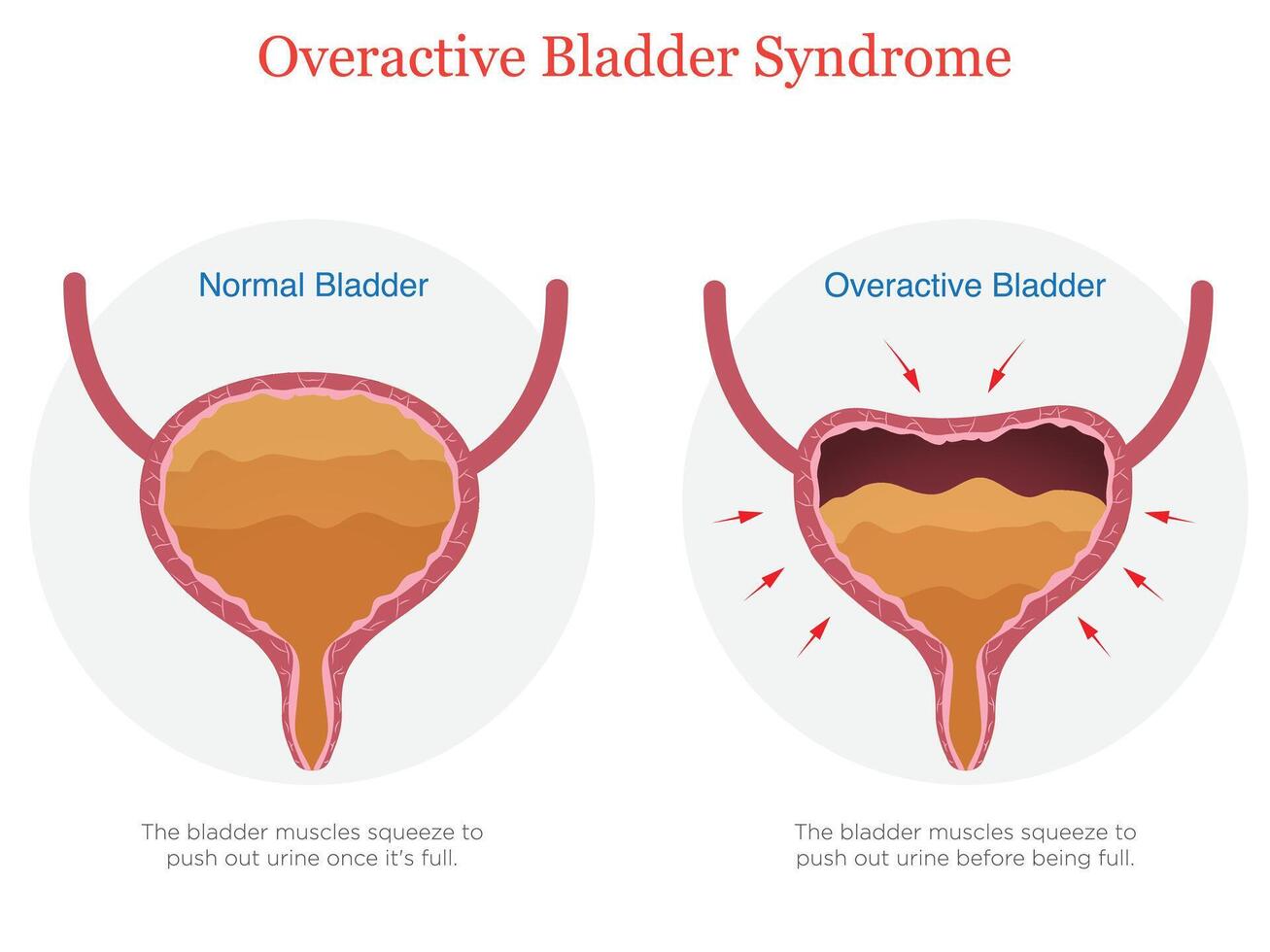 Illustration of Overactive Bladder Disorder and Effects vector