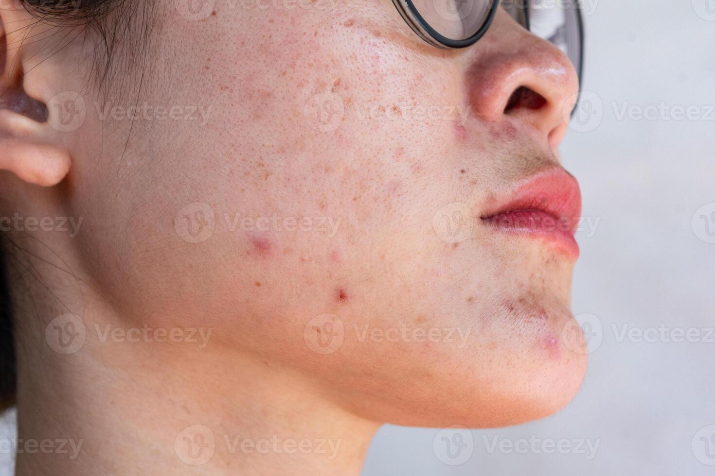 Cropped shot view of Asian woman having skin problem such as acne, scar, wrinkled occur on her face. Allergies, irritants, genetic makeup, etc can cause skin conditions. photo