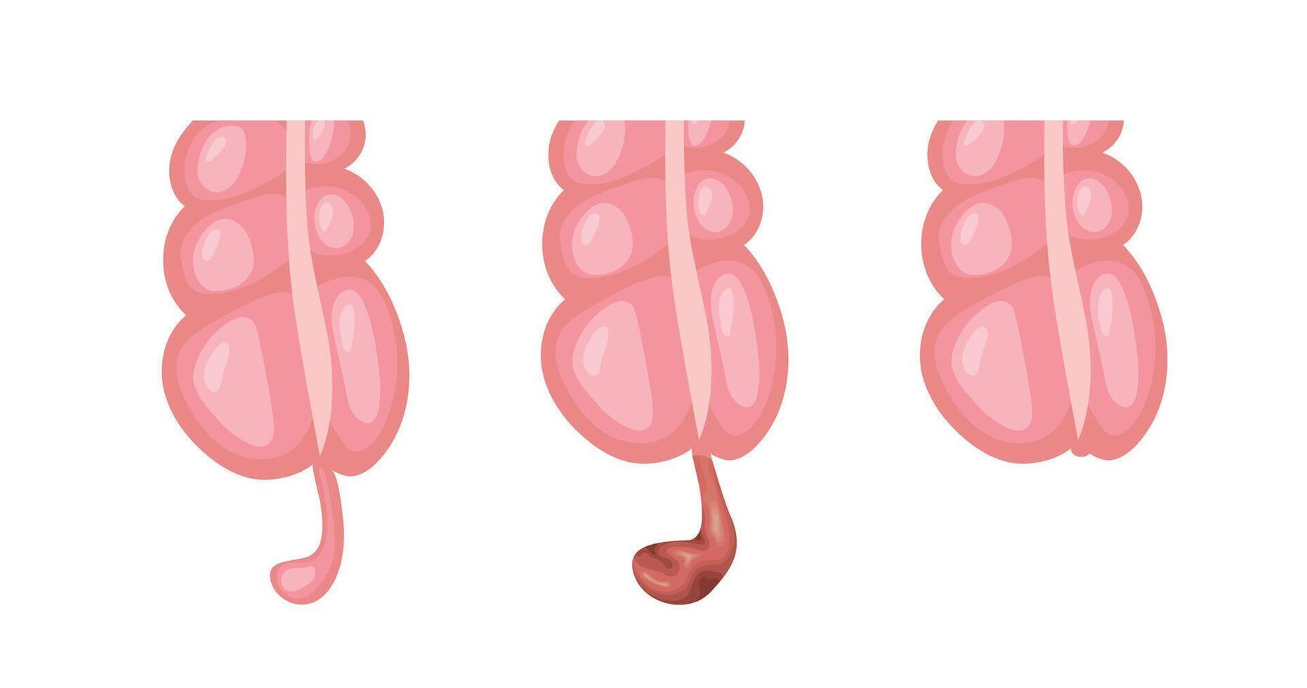 Appendicitis inflammation developing in three stages, from normal appendix to infected appendix vector