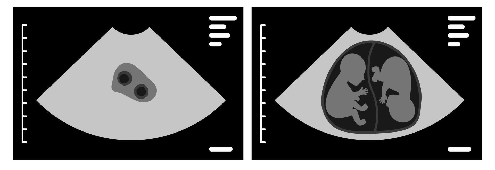 Ultrasound scan showing dizygotic twins during pregnancy vector
