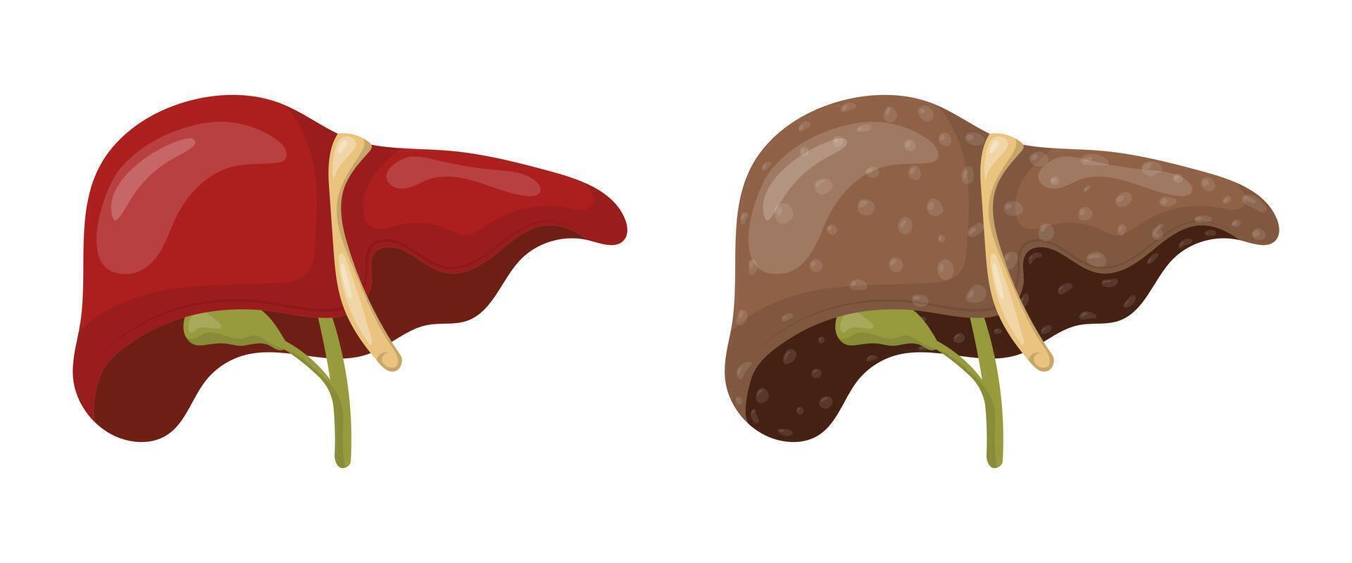 Healthy liver and cirrhotic liver showing cirrhosis medical concept vector