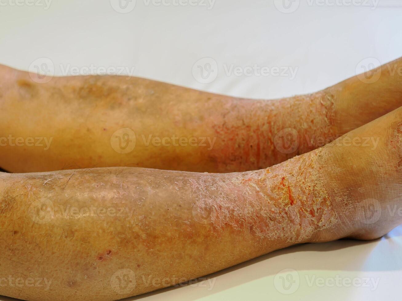A man has an itchy wound on his ankle. photo