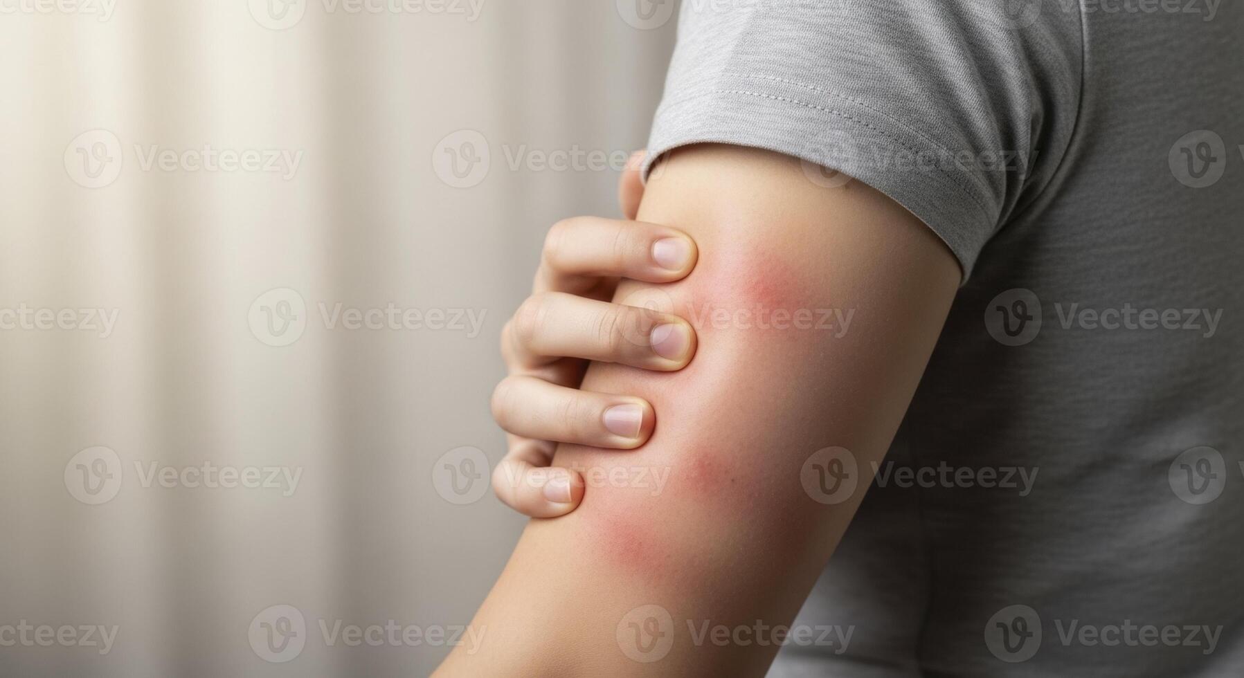 Person arm with red, inflamed skin from an allergic reaction or insect bite, showing discomfort. photo