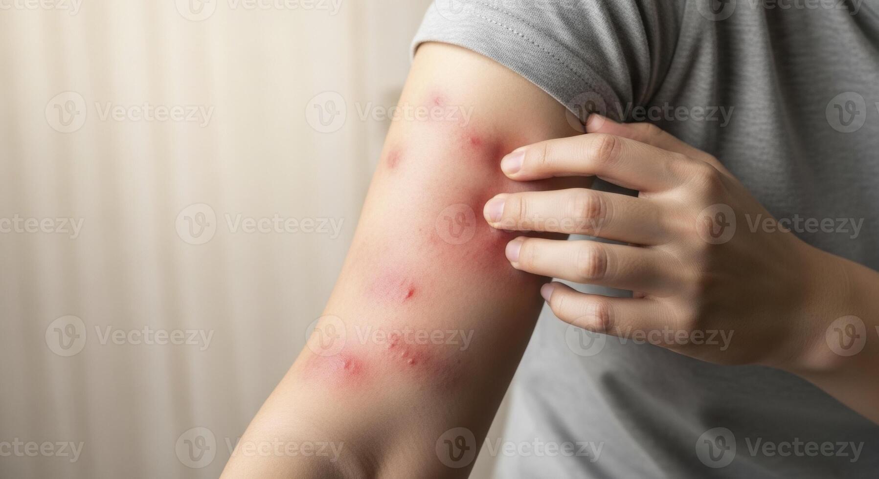Person arm with red itchy rash or insect bites, hand scratching irritated skin. photo
