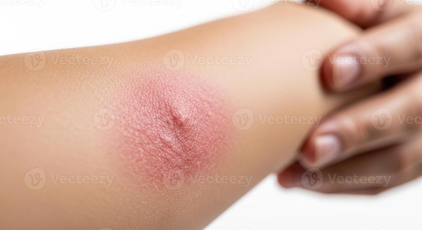 Close up of a red inflamed skin irritation on a human arm, possibly an allergic reaction photo