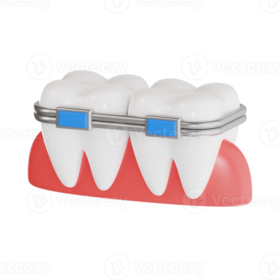 Orthodontic Braces on Teeth 3D Render png