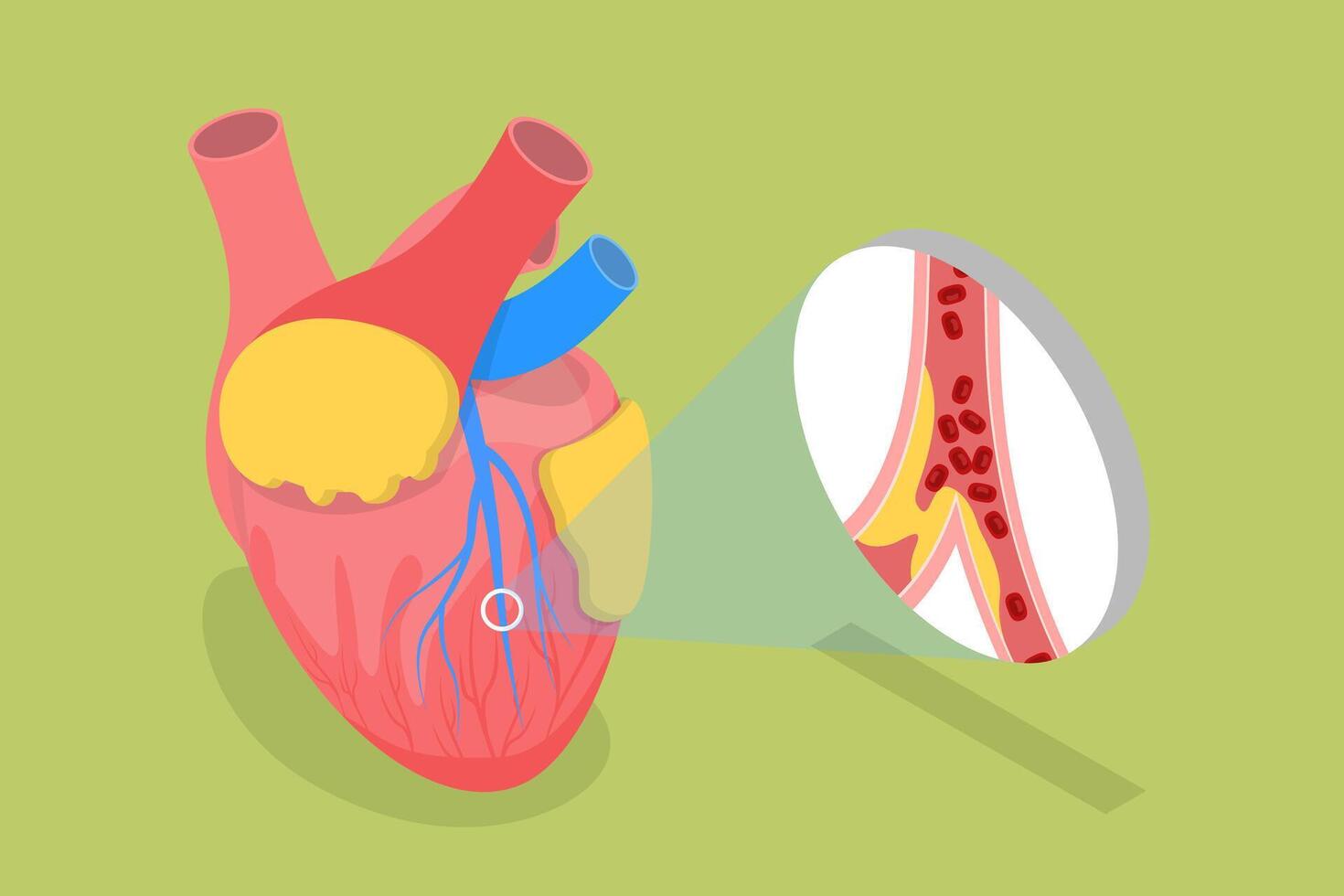 3D Isometric Flat Conceptual Illustration of Myocardial Infarction, Heart Attack vector
