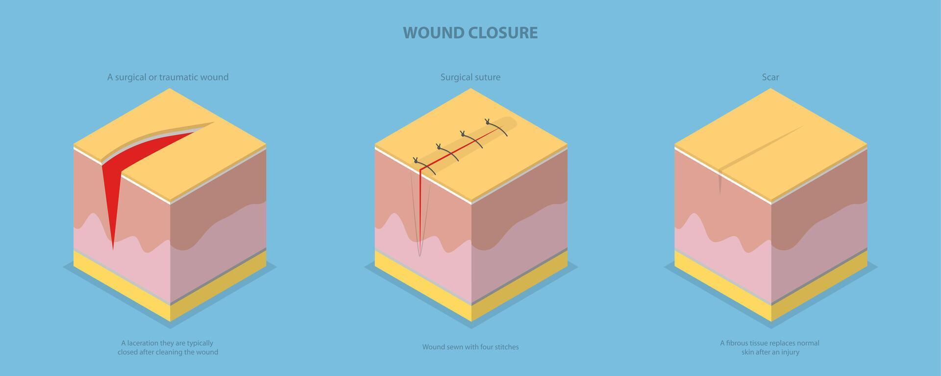 3D Isometric Flat Conceptual Illustration of Wound Closure, Tissue Injury Healing vector