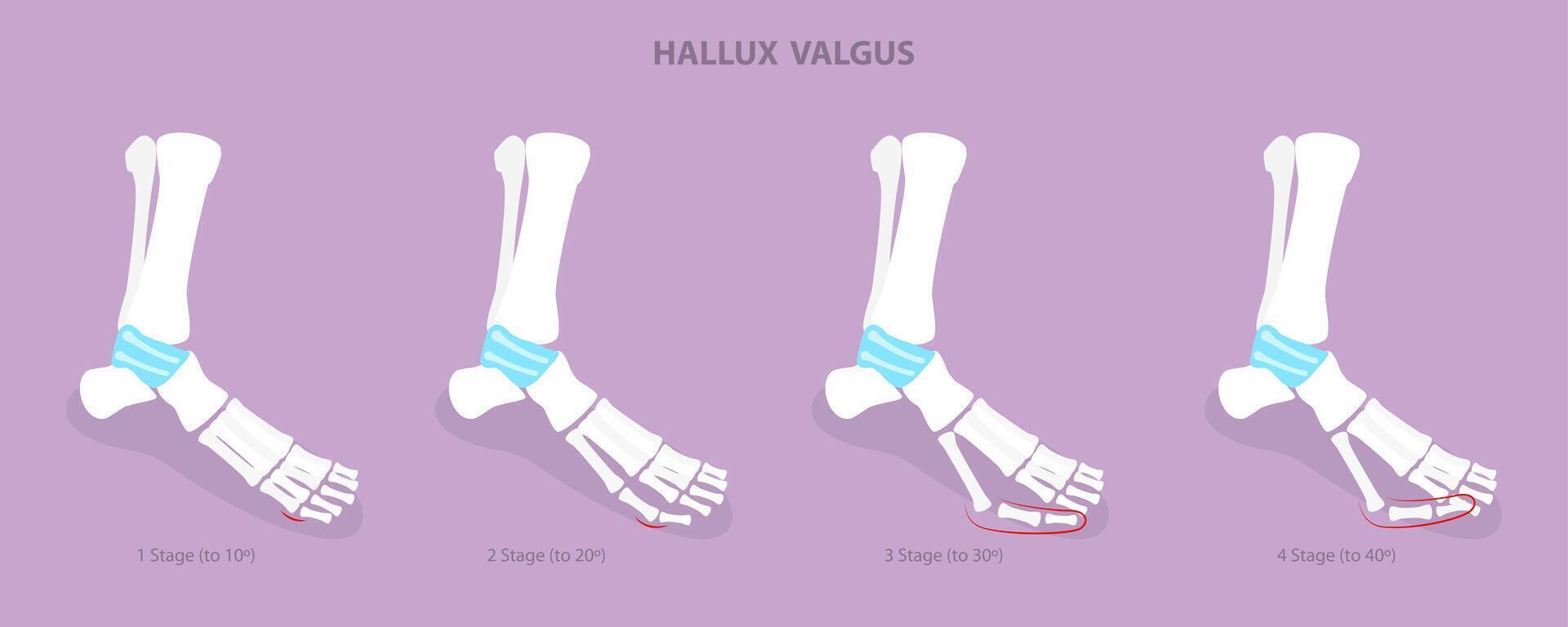 3D Isometric Flat Conceptual Illustration of Hallux Valgus, Bunion in Foot vector