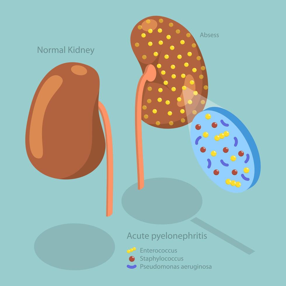 3D Isometric Flat Conceptual Illustration of Acute Pyelonephritis, Urinary Tract Infection vector