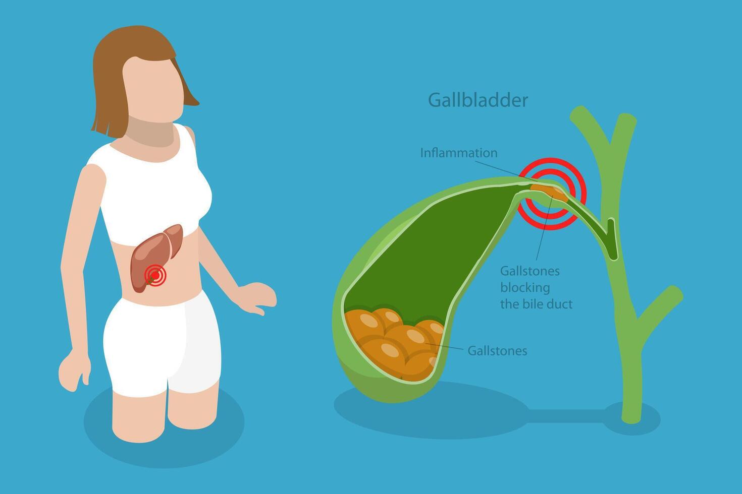 3D Isometric Flat Conceptual Illustration of Gallstone Disease, Formations in the Gallbladder vector