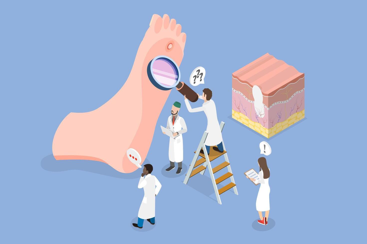 3D Isometric Flat Conceptual Illustration of Foot Wart, Swollen Skin with Rough, Yellowing Patch vector