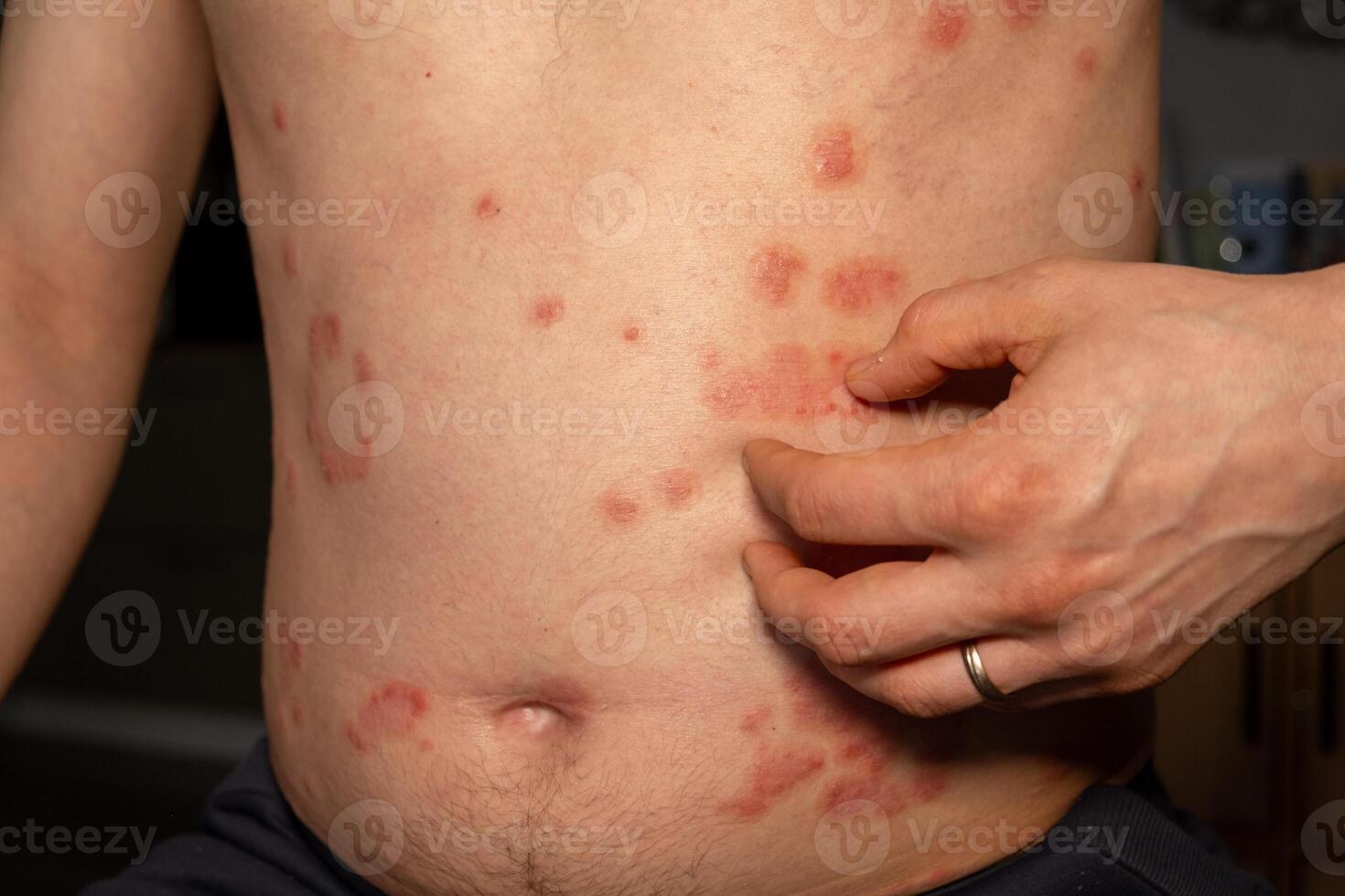 Skin patches associated with psoriasis presenting on the torso of an individual experiencing itchiness photo