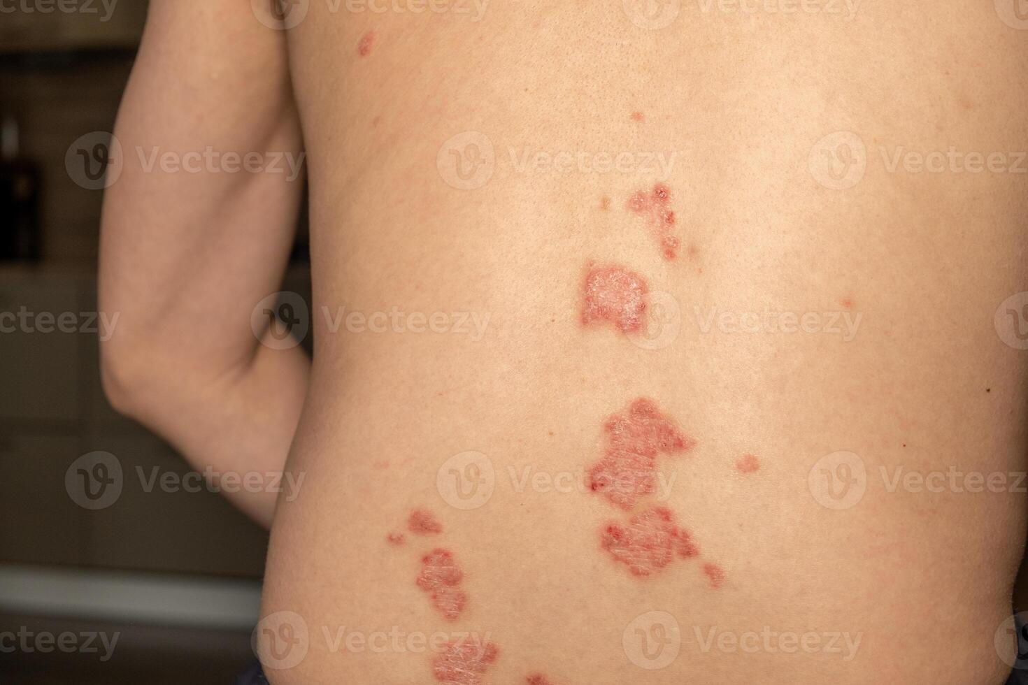 Psoriasis skin patches on a persons back indicate a chronic immune condition affecting appearance and comfort photo