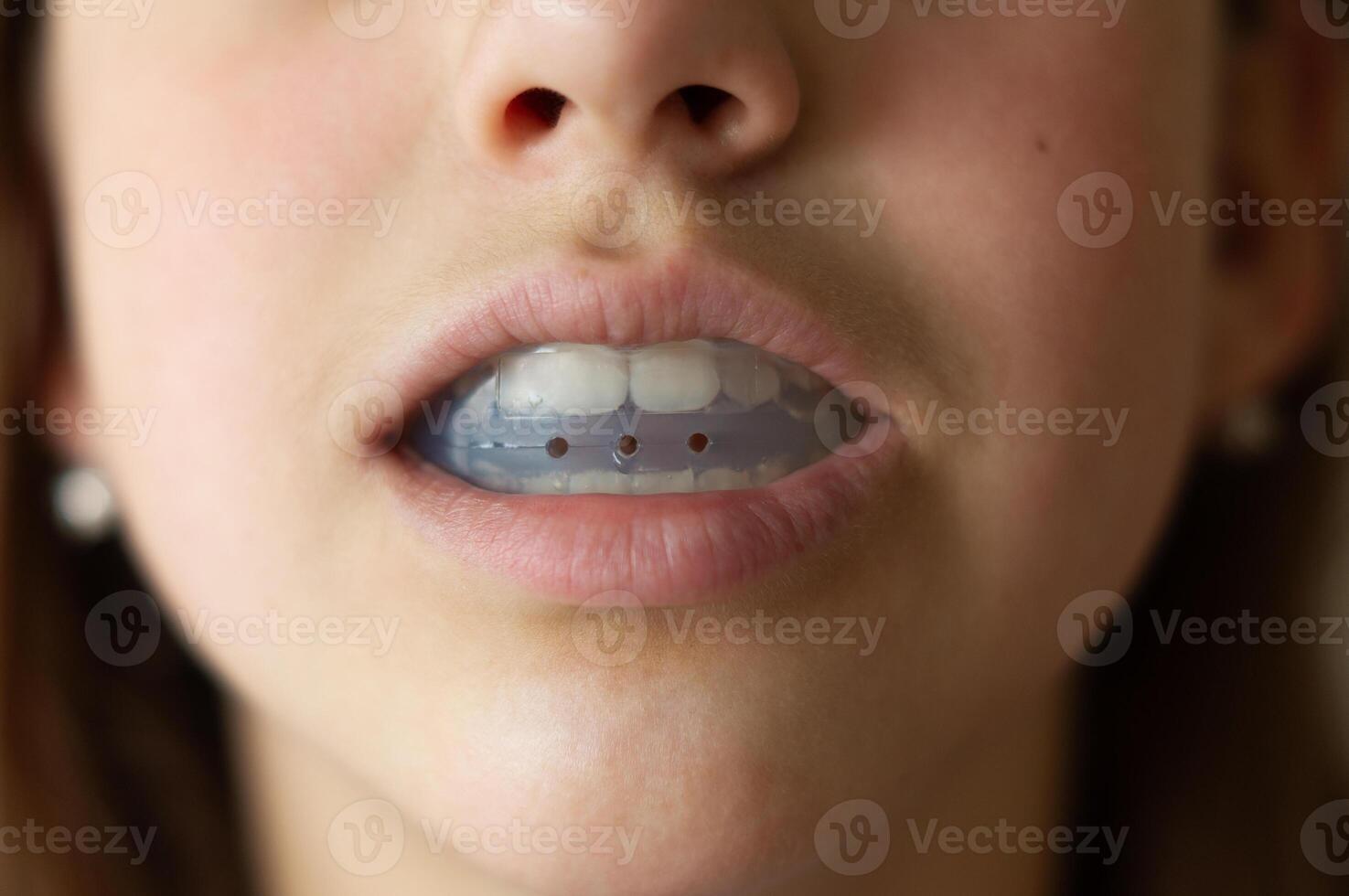 A child or girl or young woman holds a silicone orthodontic cap in her mouth to straighten her teeth photo