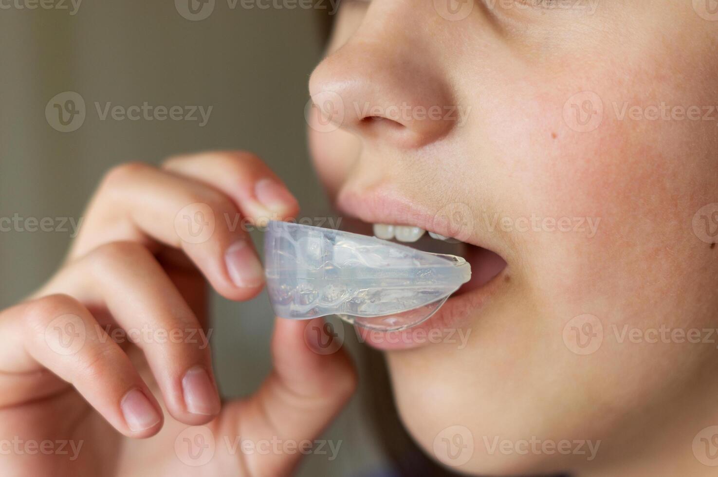 A child or teenager inserts a clear mouth guard into his mouth to straighten his teeth or bite. Side view, close-up. Orthodontic treatment photo