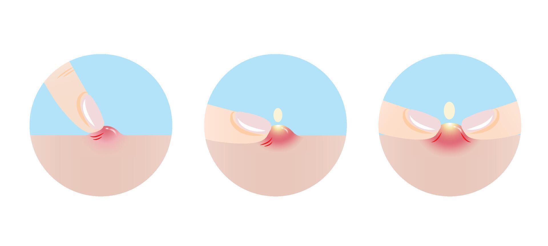 The icon set of pick at pimple, popping and squeezing acne with fingers on skin illustration. It is not good to squeeze pimples, can cause scarring and infection. Skin care and beauty concept. vector