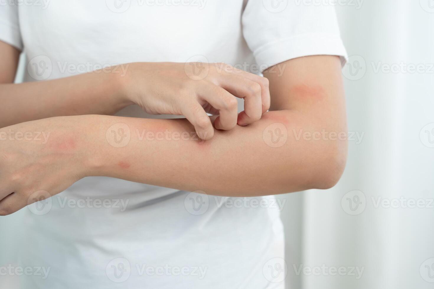 skin problem and beauty. woman scratch body has itchy skin from skin allergic, steroid allergy, sensitive skin, red from sunburn, chemical allergy, rash Seborrheic Dermatitis. photo