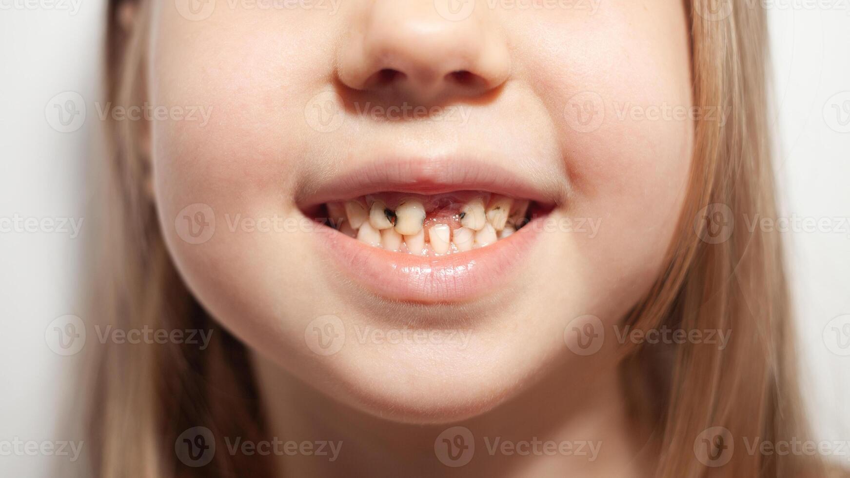 Close-up of girl showing decayed teeth due to lack of hygiene photo