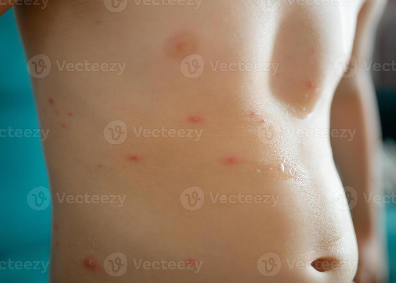 Varicella virus or Chickenpox bubble rash on child, baby or adult photo