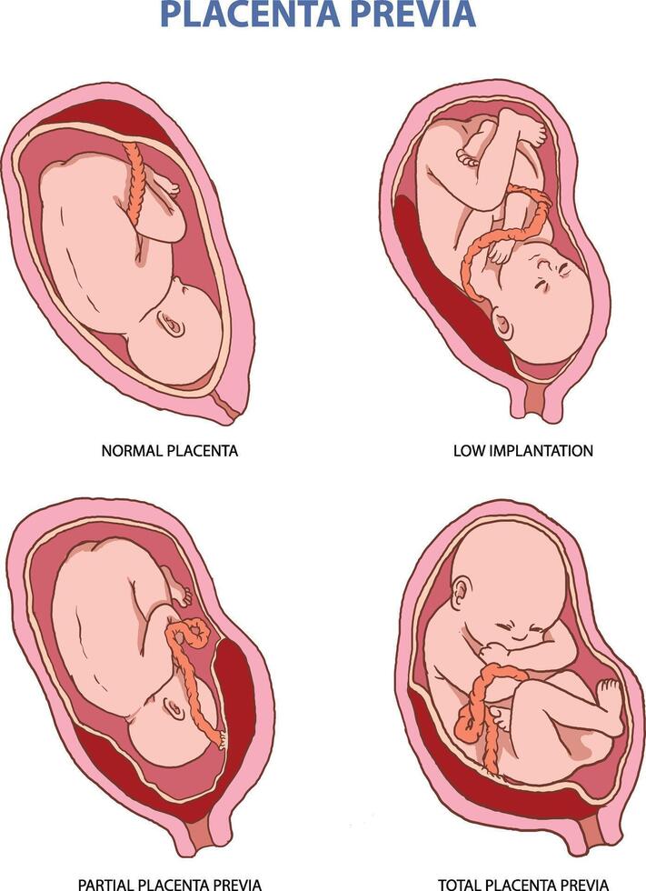 illustration of placenta previa types vector