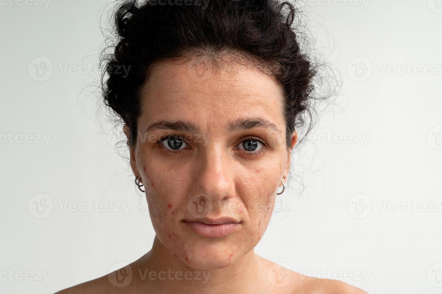 Portrait of a young woman with skin texture with red pimples, irritation and clogged pores, which indicates dermatological problems with skin care. Hormonal acne and spots on the face. photo