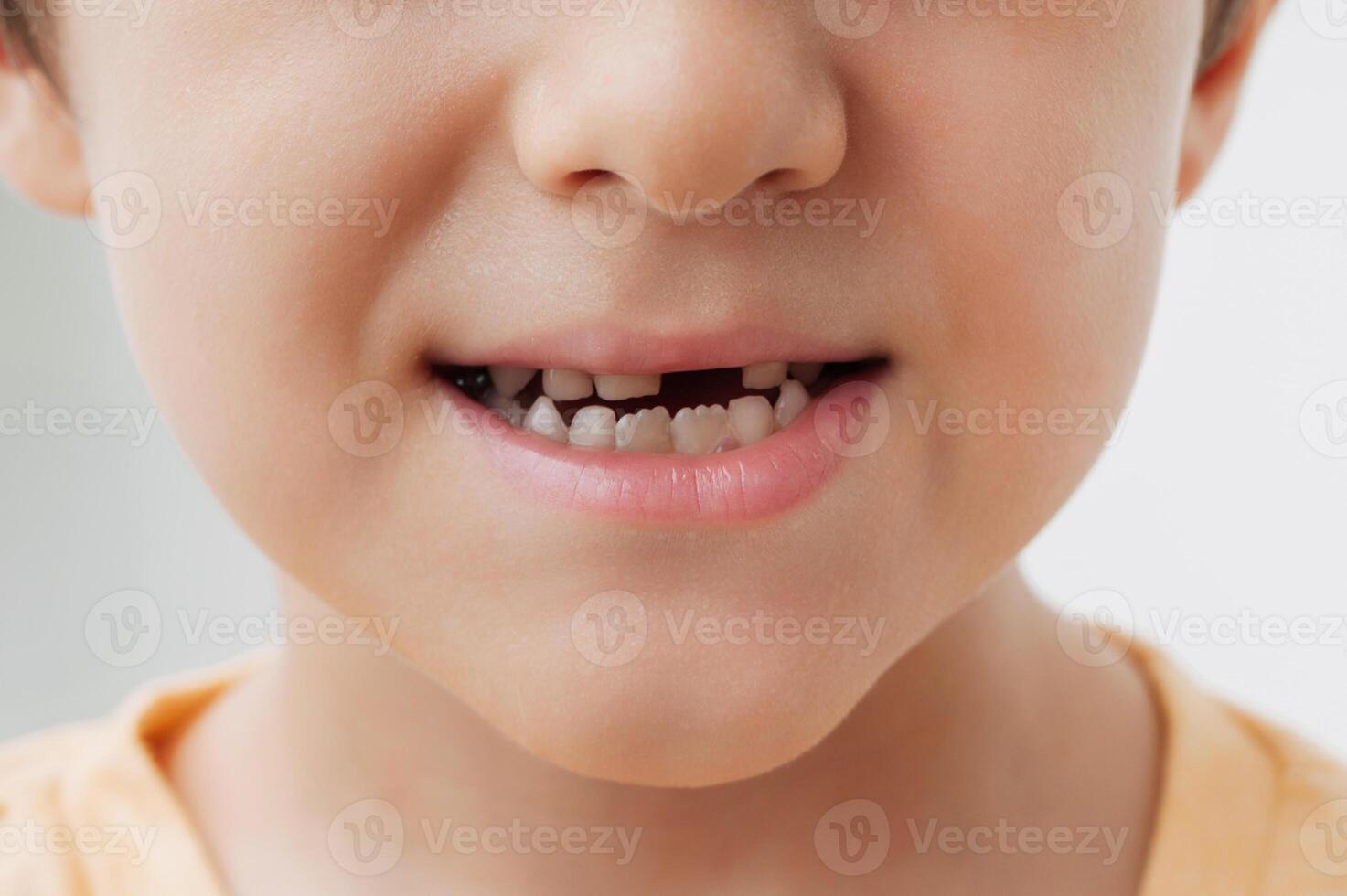 The smile of a little boy without a baby tooth. The child's front baby tooth falls out and a new adult tooth grows. Oral care in children. photo