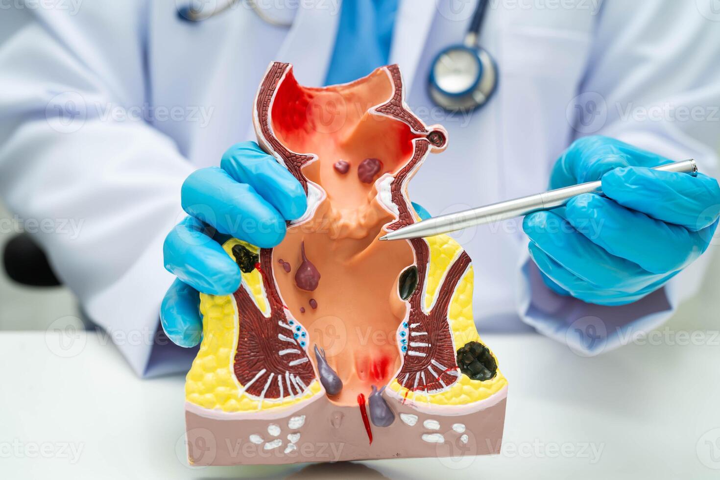 doctor with rectum and hemorrhoid human anatomy model at hospital, inflamed photo