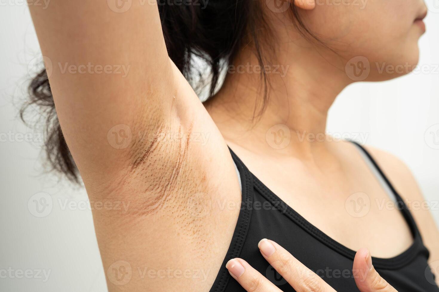 Asian woman have problem black armpit beauty skin care. photo