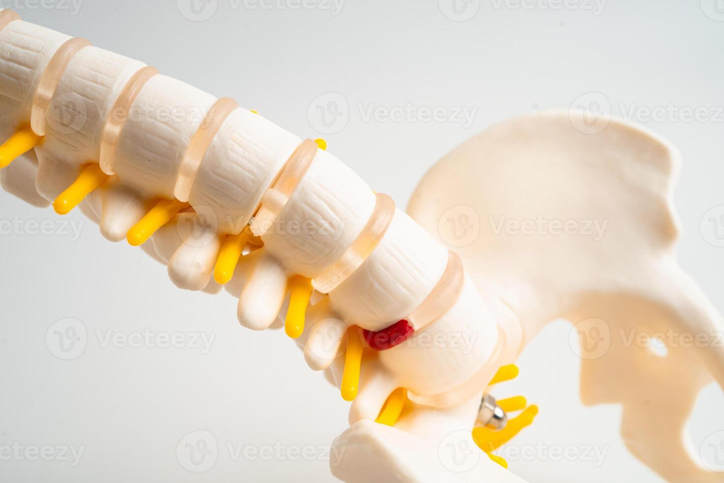 Spinal nerve and bone Lumbar spine displaced herniated disc fragment, Model for treatment medical in the orthopedic department. photo