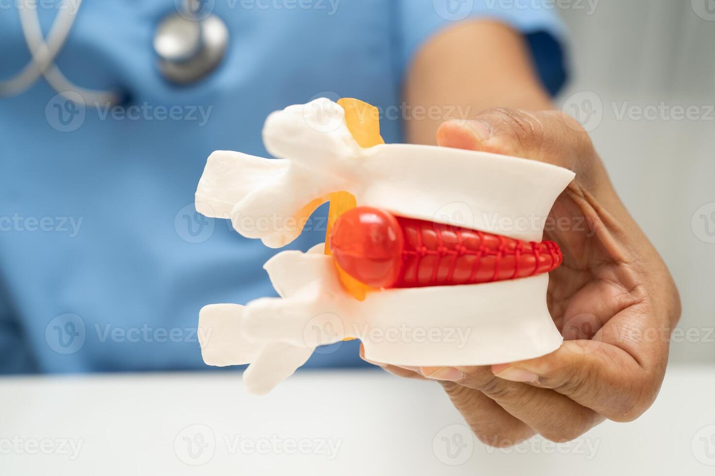 spinal nerve and bone model, Lumbar spine displaced herniated disc fragment photo