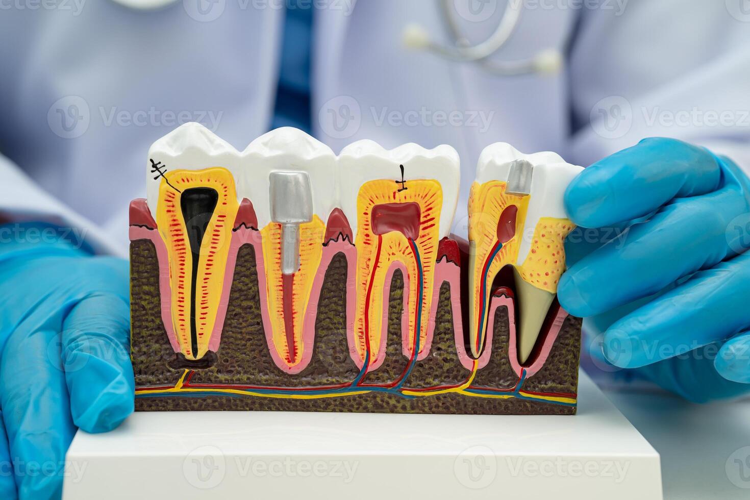Dental implant artificial tooth roots into jaw, root canal of dental treatment, gum disease, photo