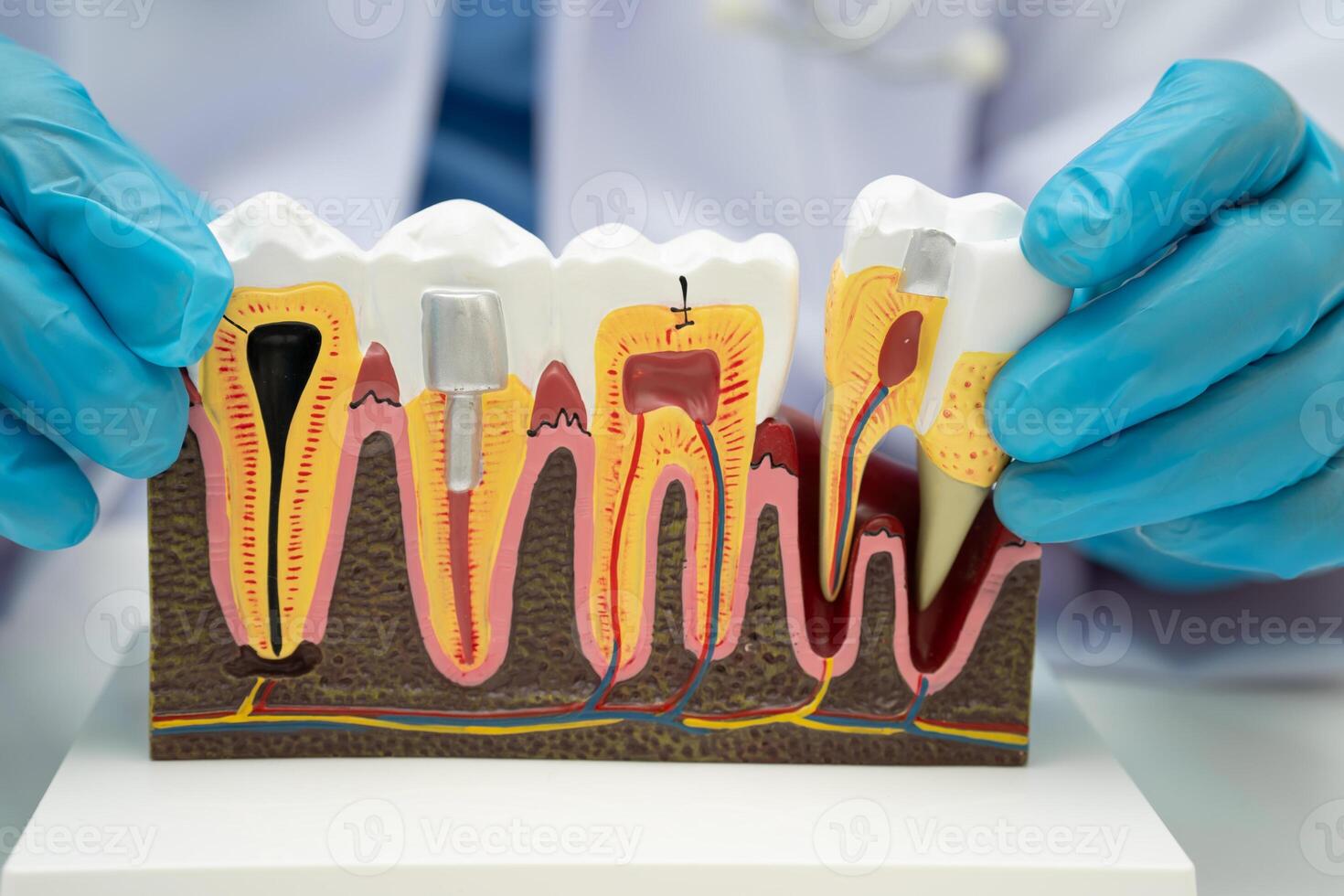 Dental implant artificial tooth roots into jaw, root canal of dental treatment gum disease photo