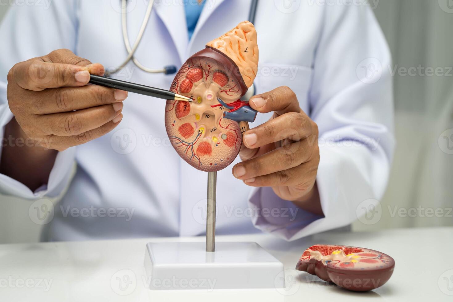 Chronic kidney disease, doctor with model treatment urinary photo