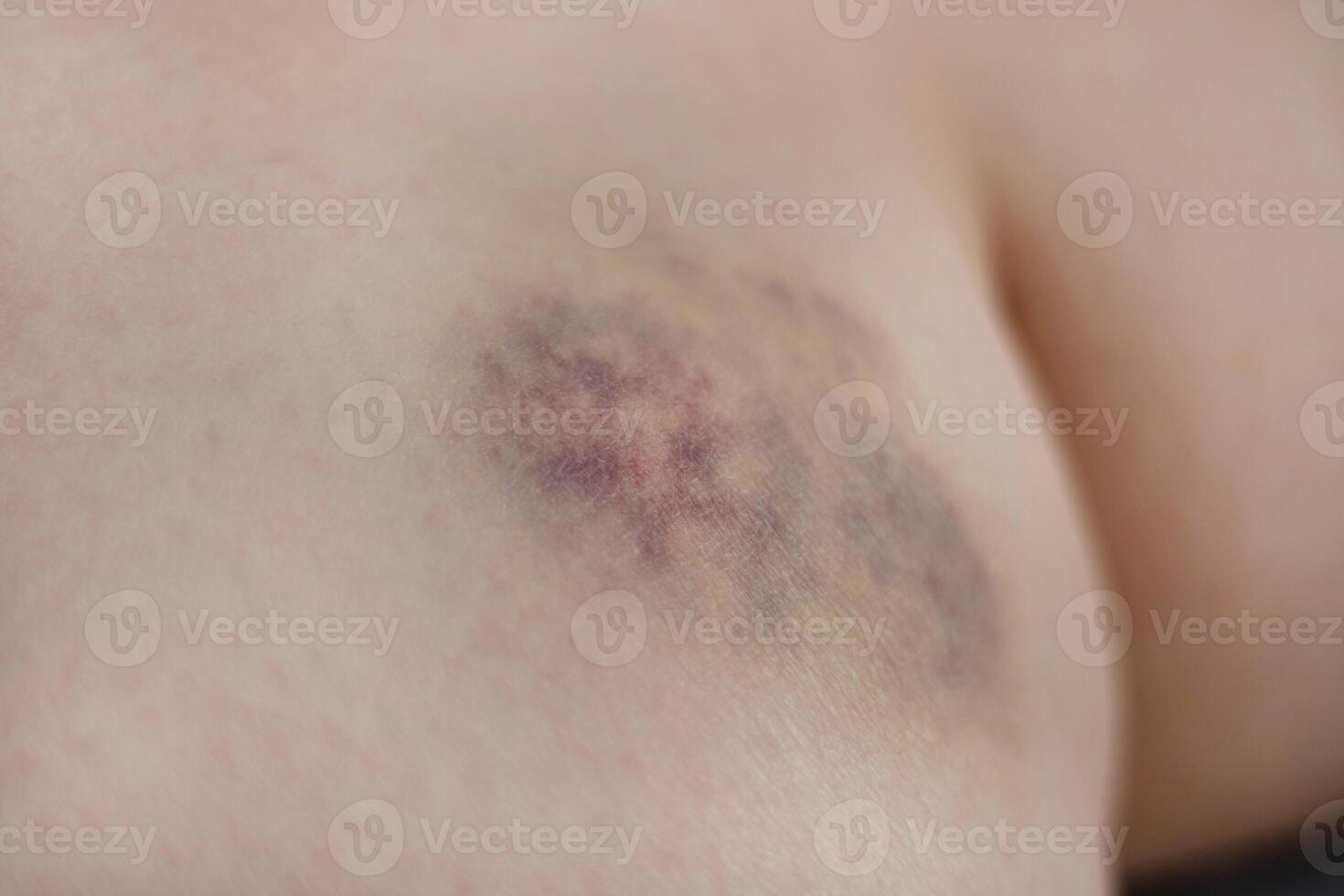Close-up of healing bruise showing purple and yellow colors. bruise on inner thigh near knee photo
