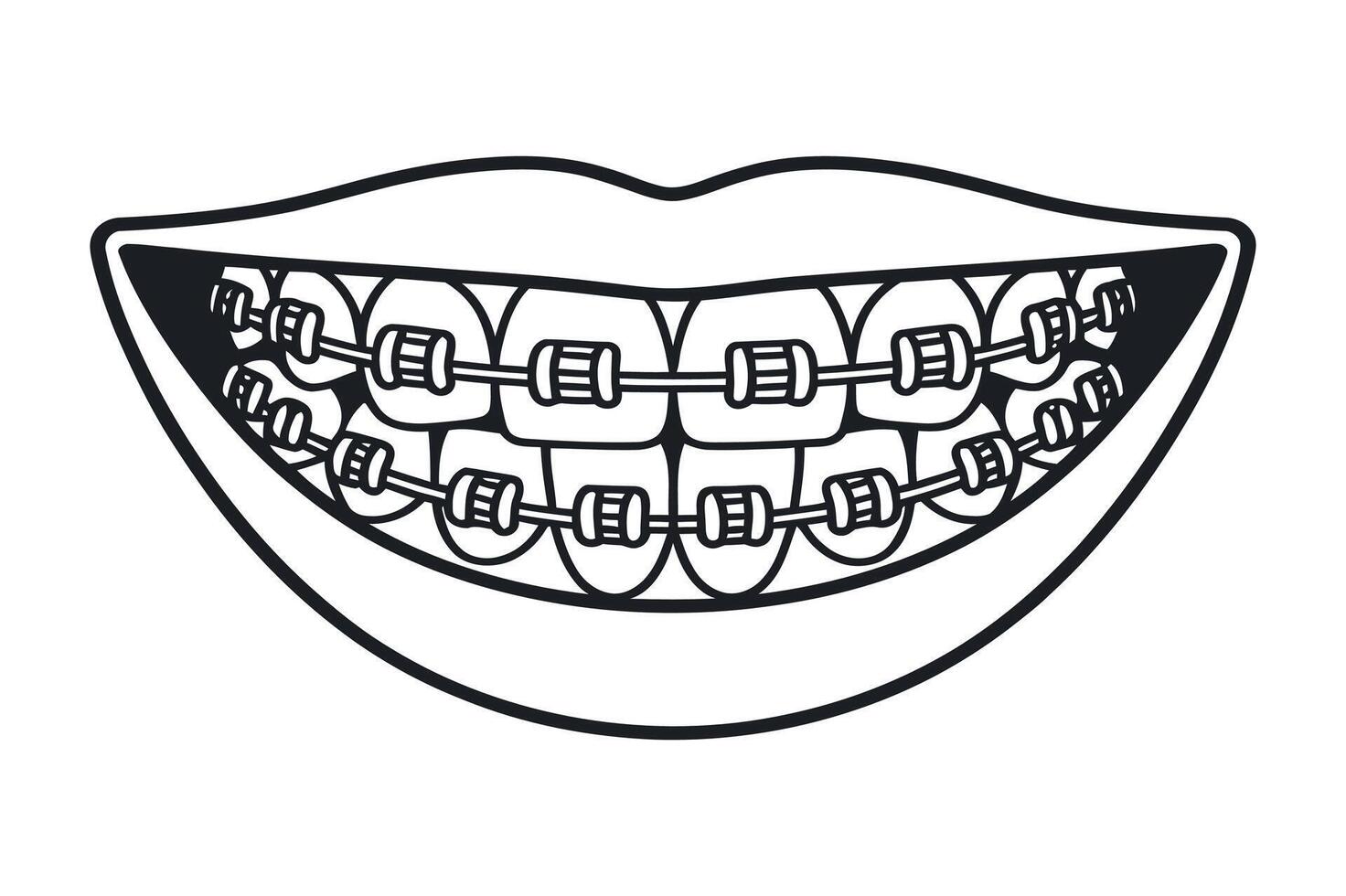 Illustration of a Smiling Mouth with Teeth Fitted with Braces Orthodontic Treatment for Dental Alignment and Improved Oral Health and Aesthetics vector