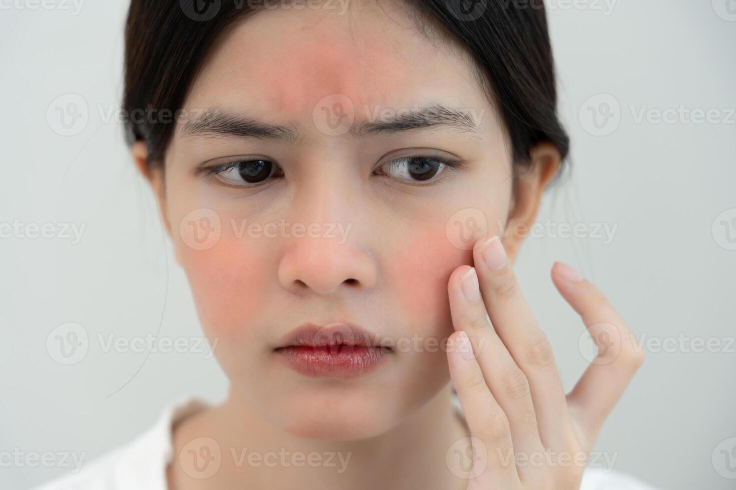 Young woman worry about faces Dermatology and allergic to steroids in cosmetics. sensitive skin, red face from sunburn, acne, allergic to chemicals, rash on face. skin problems and beauty photo