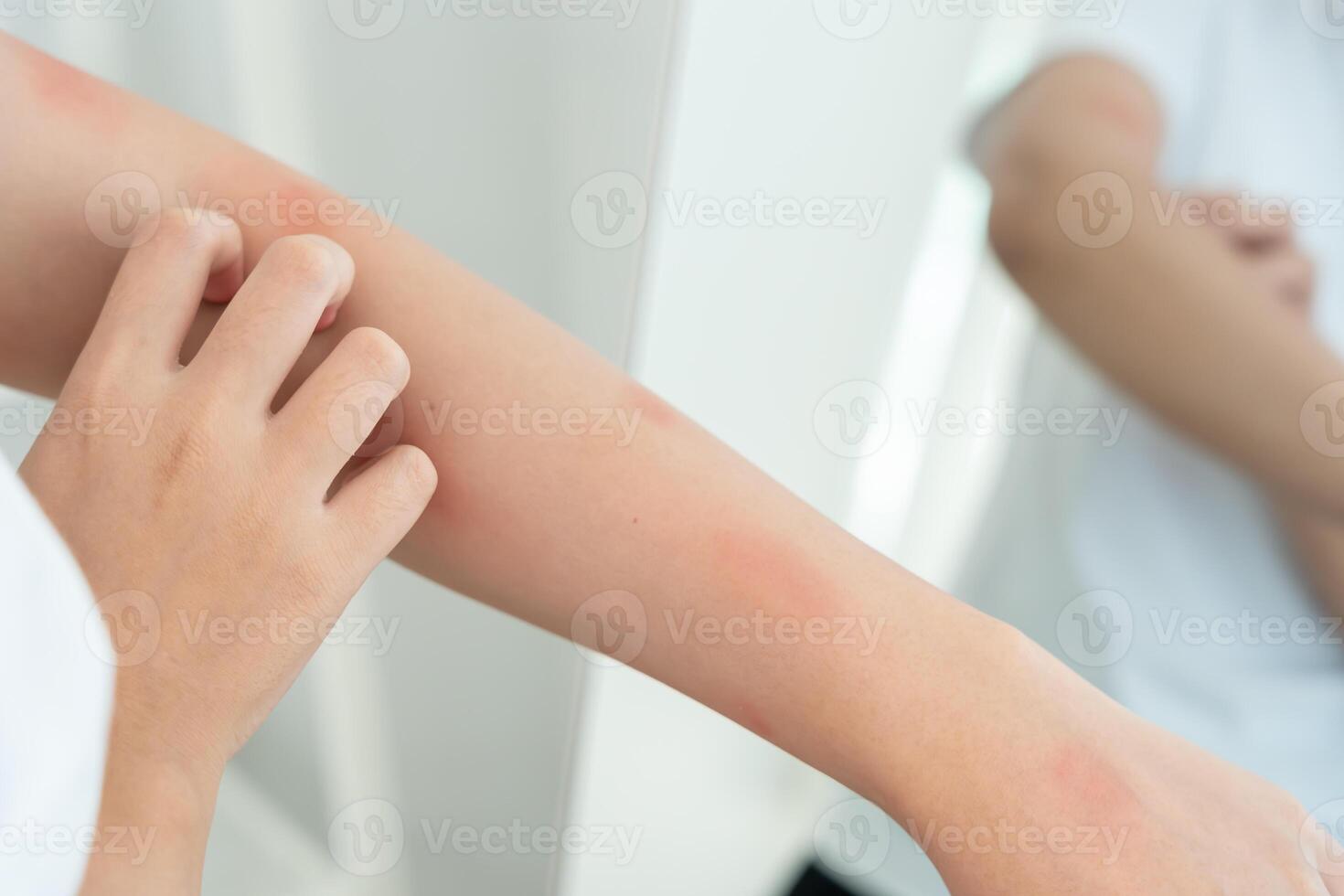 skin problem and beauty. Young woman scratch body has itchy skin from skin allergic, steroid allergy, sensitive skin, red from sunburn, chemical allergy, insect bites photo
