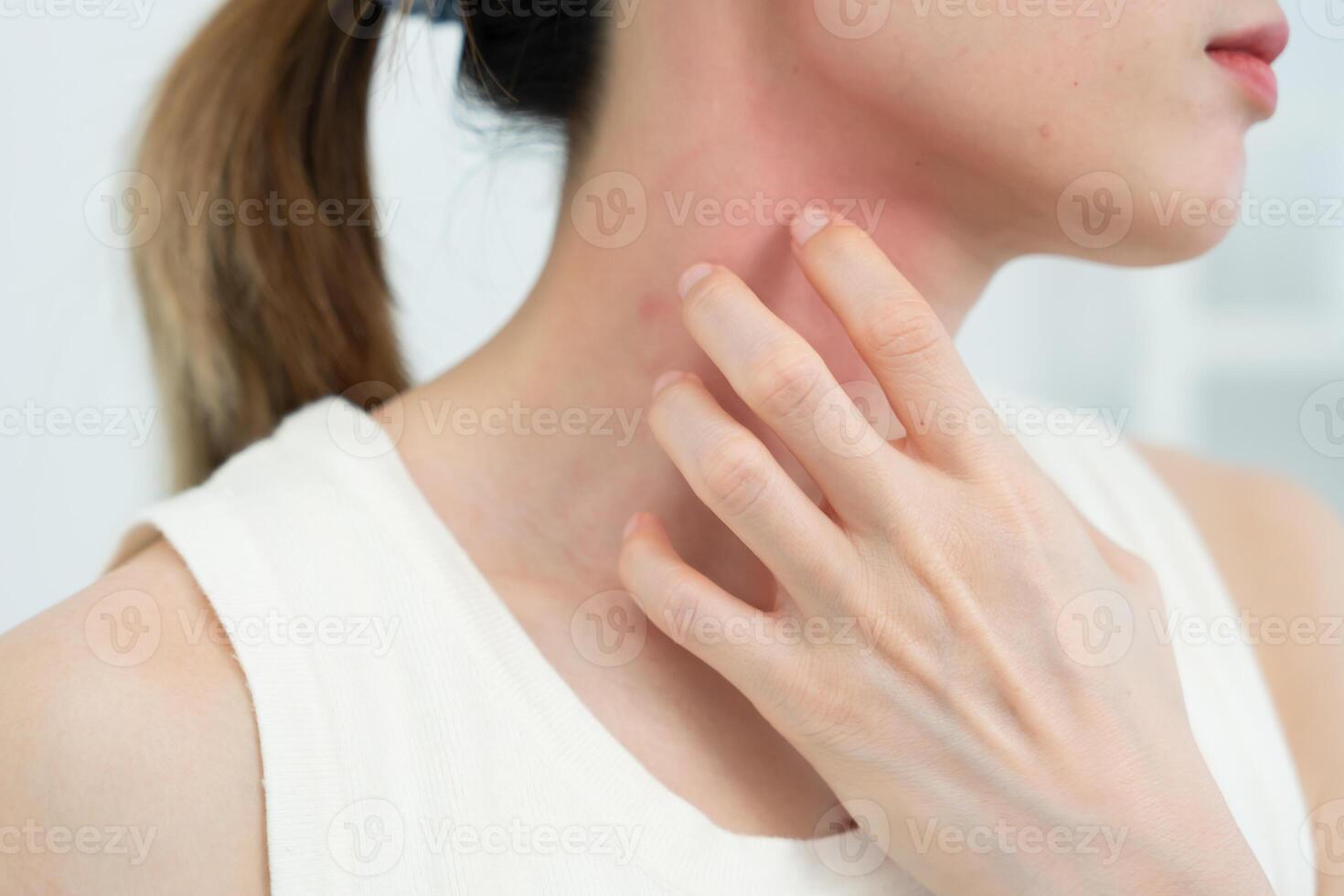 skin problem and beauty Young woman scratch body has itchy skin from skin allergic, steroid allergy, sensitive skin, red from sunburn, chemical allergy, rash, insect bites Seborrheic Dermatitis photo