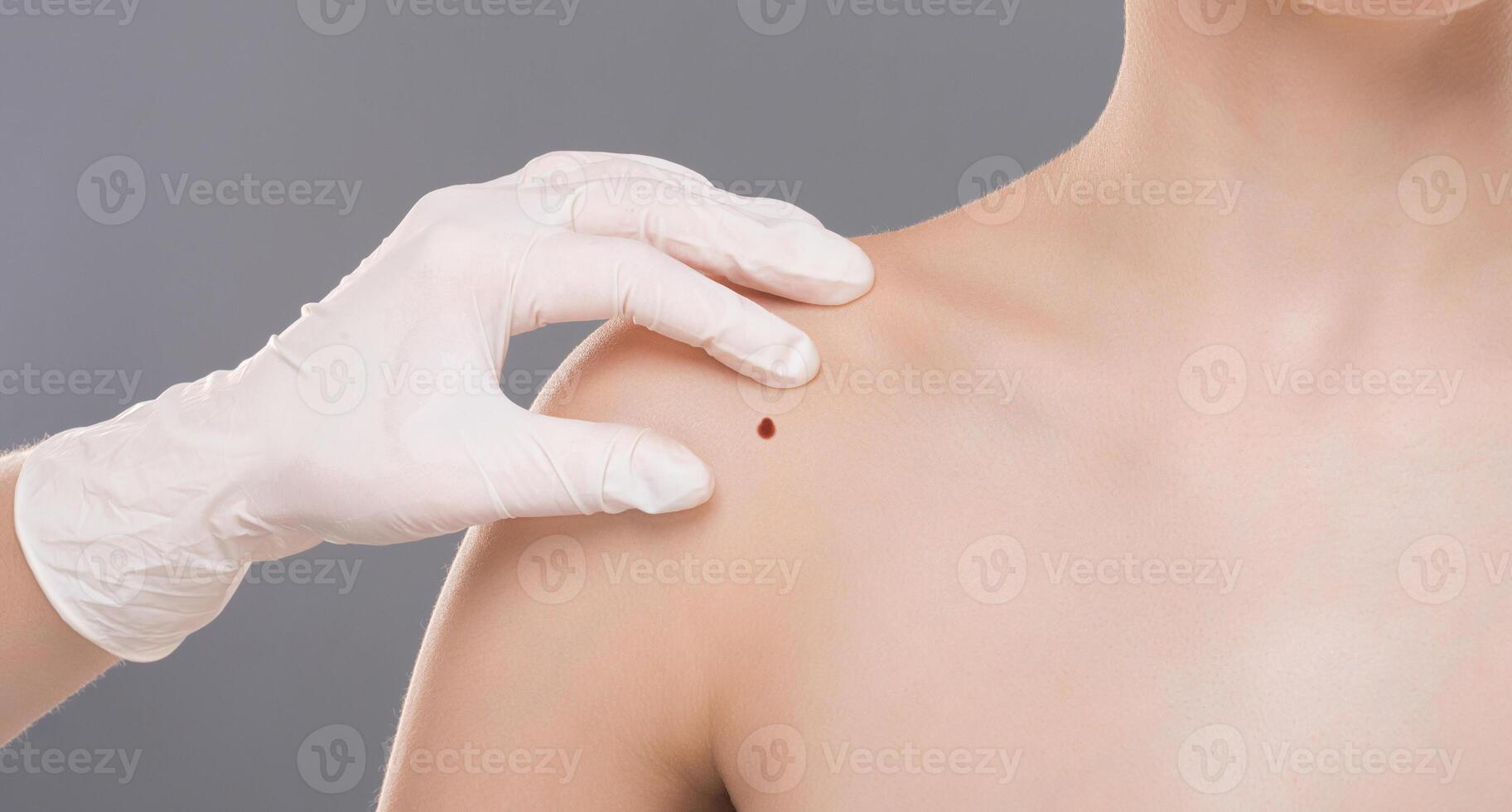 Dermatologist examining birthmark on woman shoulder, closeup. Cancer prevention concept, empty space photo