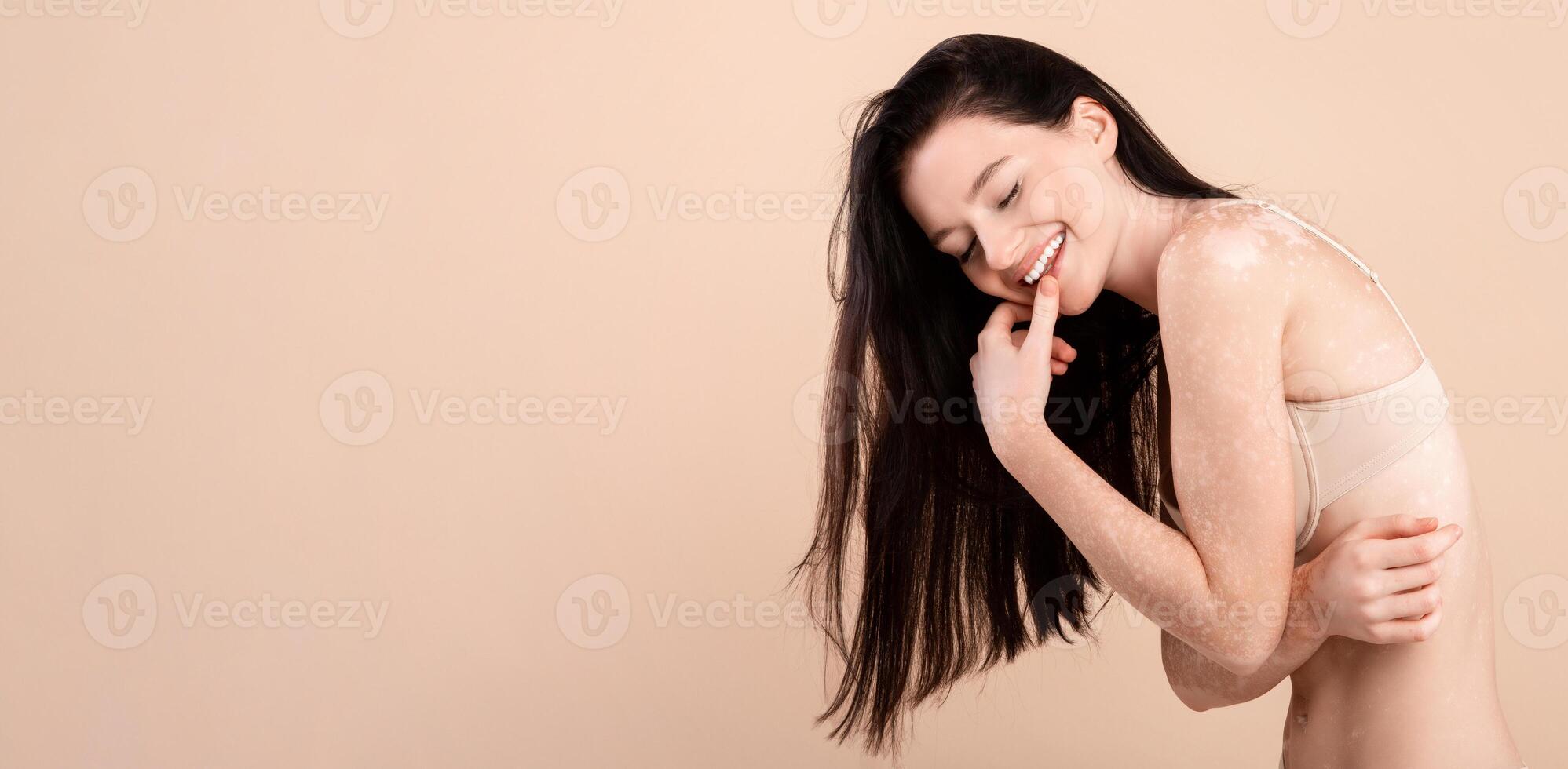 Body Acceptance. Portrait Of Happy Beautiful Lady With Vitiligo Skin Wearing Underwear, Smiling Young Skinny Female With White Pale Patches On Her Body Posing Over Beige Background, Copy Space photo