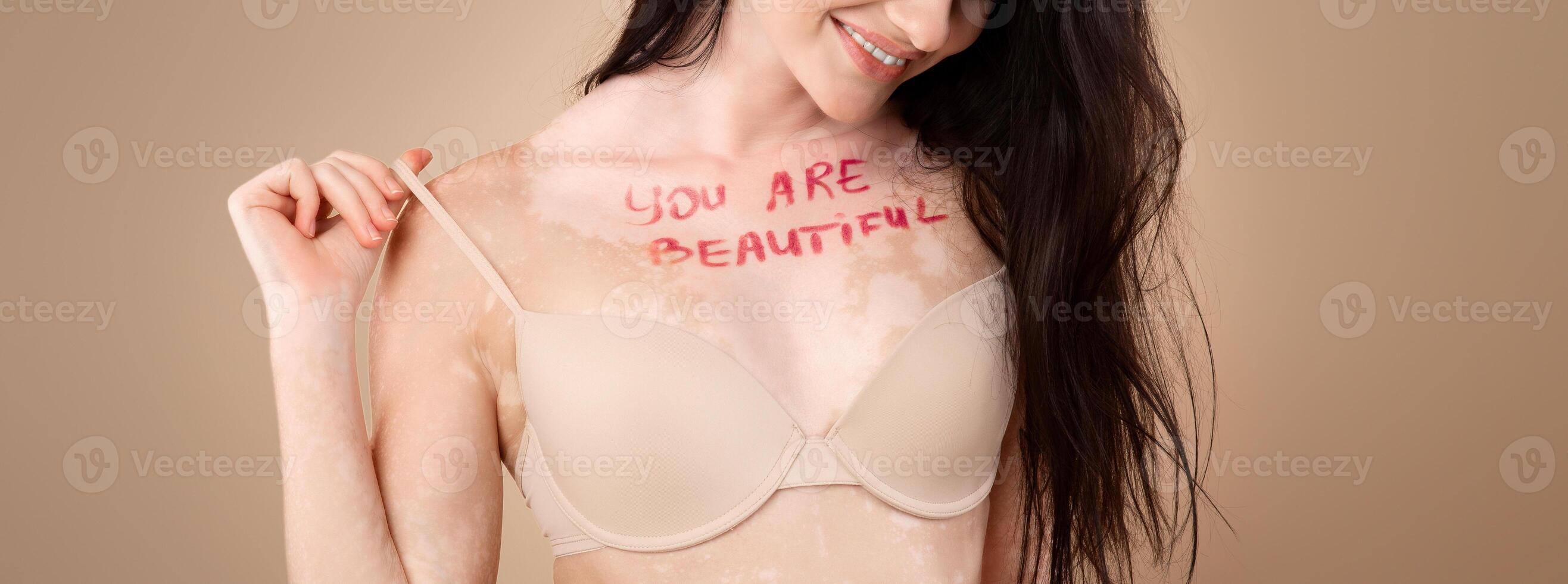 Self-Acceptance. Portrait Of Proud Woman With Vitiligo Skin Having Written You Are Beautiful Inscription On Chest, Cheerful Body Positive Lady Posing In Bra Over Beige Studio Background, Copy Space photo