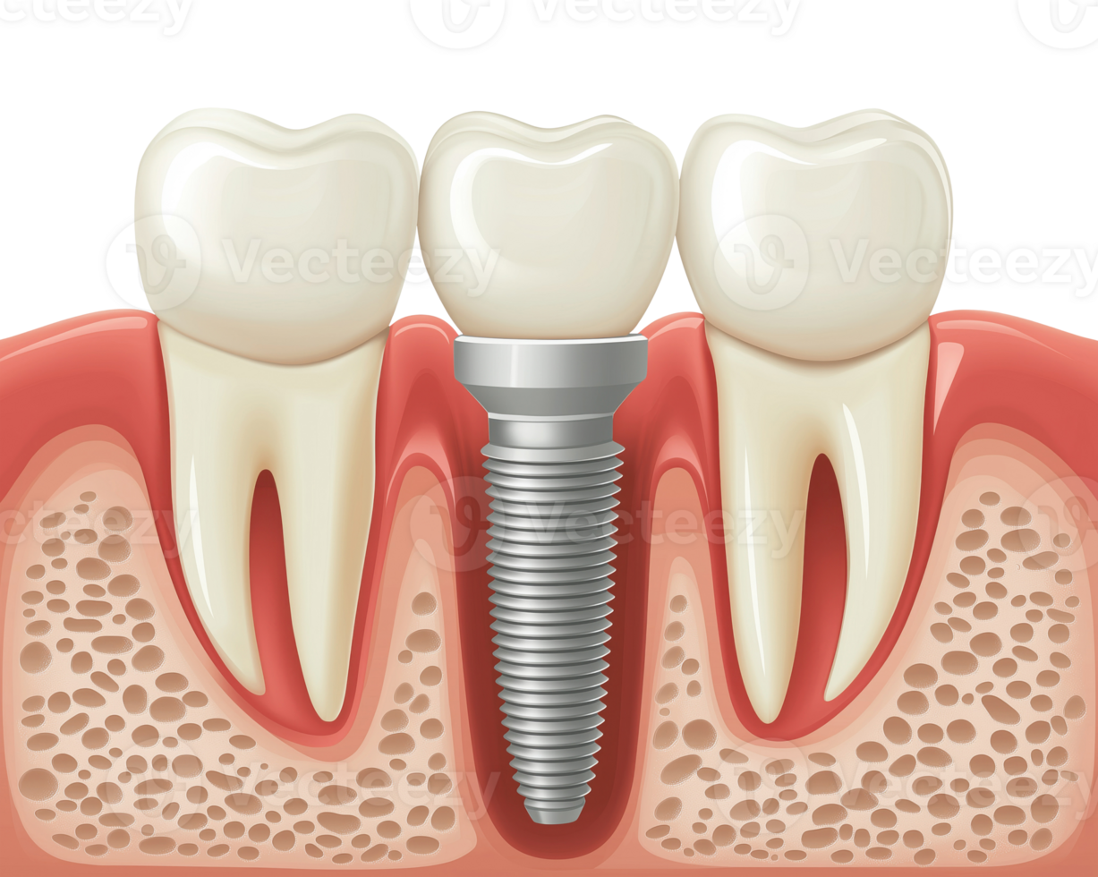 Illustration of dental implant with titanium screw between natural teeth in gums, isolated on transparent background png