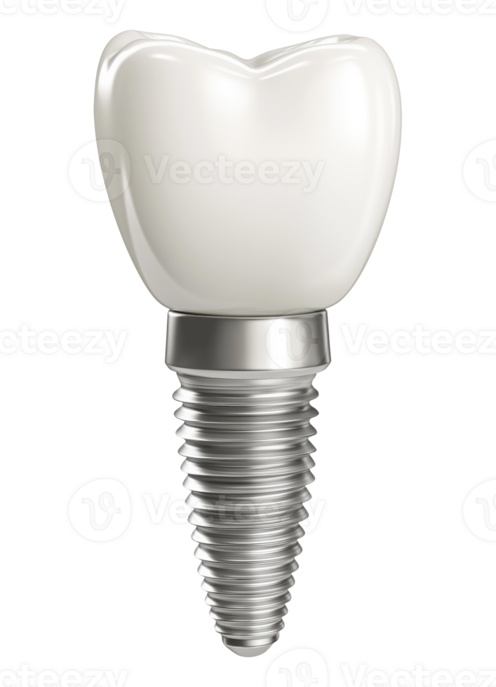 Realistic dental implant model isolated on transparent background png